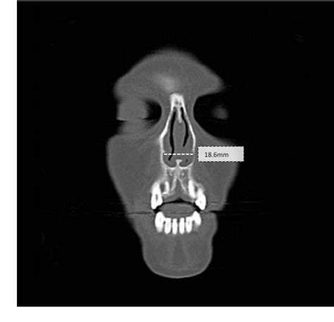 Figure 2 from Piriform aperture enlargement for nasal obstruction ...