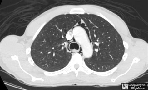 LearningRadiology - pneumomediastinum, mediastinal, emphysema, chest ...