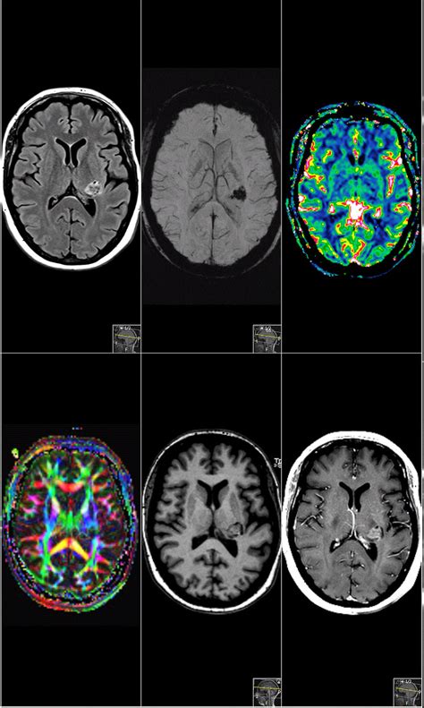 Magnetic Resonance Imaging Sagittal Cmri Reveals A Supratentorial