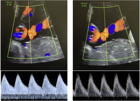 Doppler Velocimetry Discordance Between Paired Umbilical Artery Vessels And Clinical