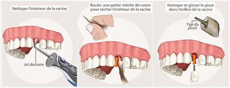 Différence Entre Implant Et Dent Sur Pivot Diverses Différences