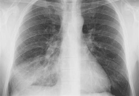 Pneumonia Tratamento Causas Sintomas E Diagnostico