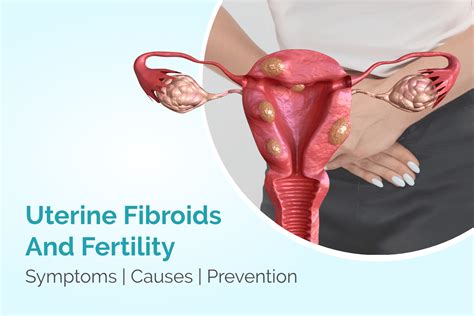 Uterine Fibroids And Fertility Symptoms Causes Prevention