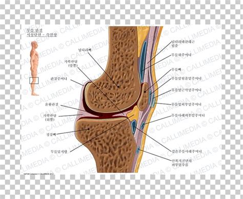 Prepatellar Bursitis Synovial Bursa Infrapatellar Bursitis Knee Png