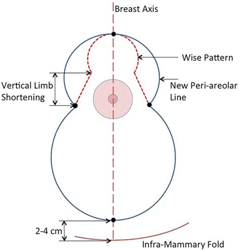 Rbcp Simplified Planning And Marking Of Mastopexy And Reduction