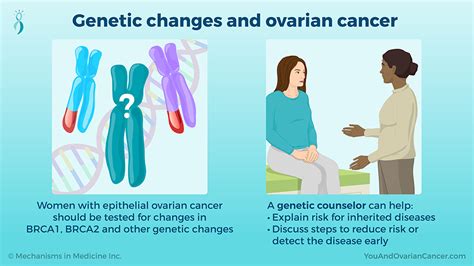 Slide Show - Understanding Ovarian Cancer 