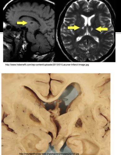 Cerebrovascular Pathology Exam Neuro Flashcards Quizlet