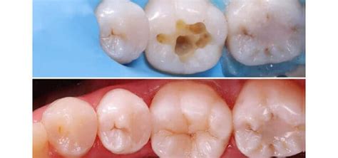 Composite En El Dentista Cu Ndo Se Usa Ferrus Bratos