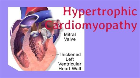 What Is Hypertrophic Cardiomyopathy Types Symptoms Causes And