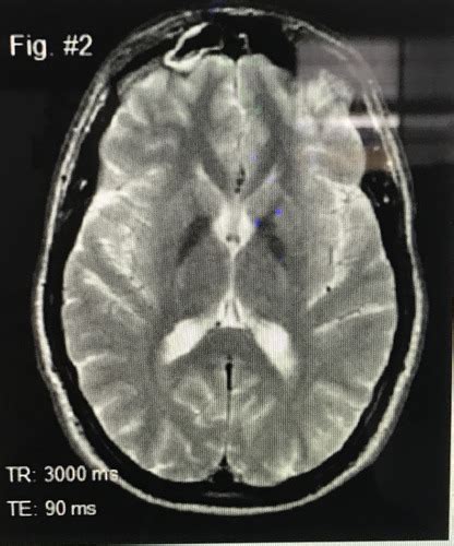 Mri Flashcards Quizlet