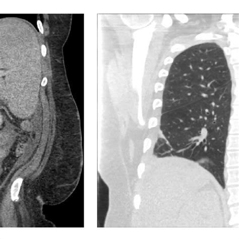 Computed Tomography Ct Of The Abdomen And Pelvis Left And Ct Of The