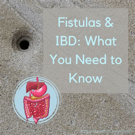 Fistulas And Ibd What You Need To Know