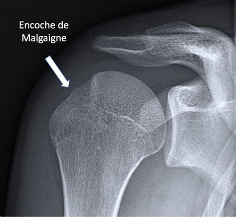 Luxations et instabilités de l épaule docteurs Bourgade et Tavernier