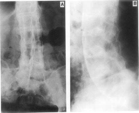 Anteroposterior A And Lateral B Radiographs Of The Lumbosacral