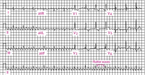 Atrial Flutter Atrial Flutter Merck Manual Professional Edition