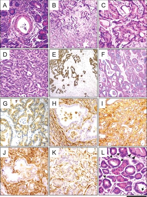 Aggressive Pancreatic Ductal Adenocarcinoma In Mice Caused By Pancreas