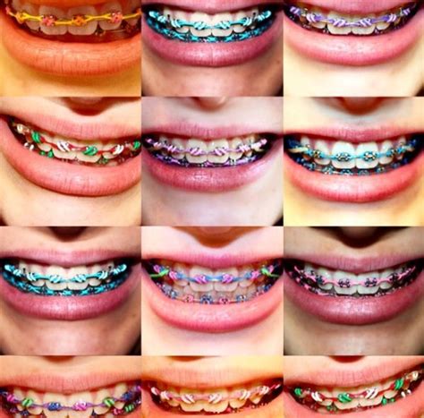 Braces Color Wheel Braces Color Wheel Happypole