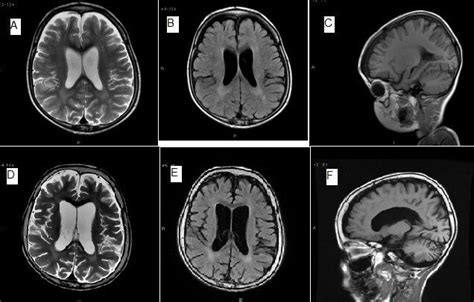 A Case Of Neuronal Ceroid Lipofuscinosis Ncl With Upper Row Images