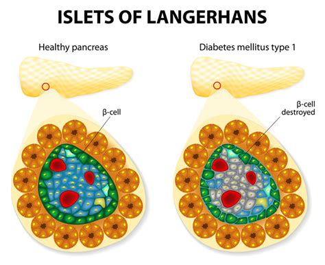 Reprogrammed pancreatic cells cure type I diabetes - European Biotechnology