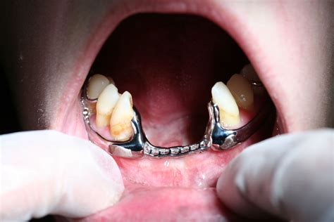Buccal Major Connector for Severe Lingual Version Mandibular Teeth