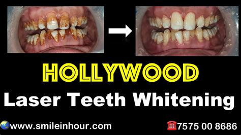 Hollywood Laser Teeth Whitening Cost Procedure Review Ahmedabadfamous