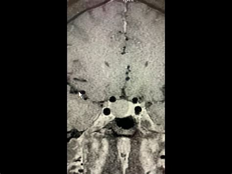 Pituitary MRI educational series : macroadenoma - Pituitary World News