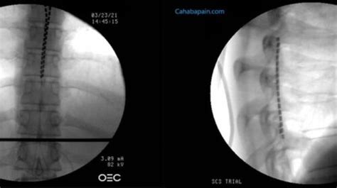 Spinal Cord Stimulation Scs Cahaba Pain And Spine Care