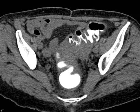 Acute Diverticulitis Colon Case Studies Ctisus Ct Scanning