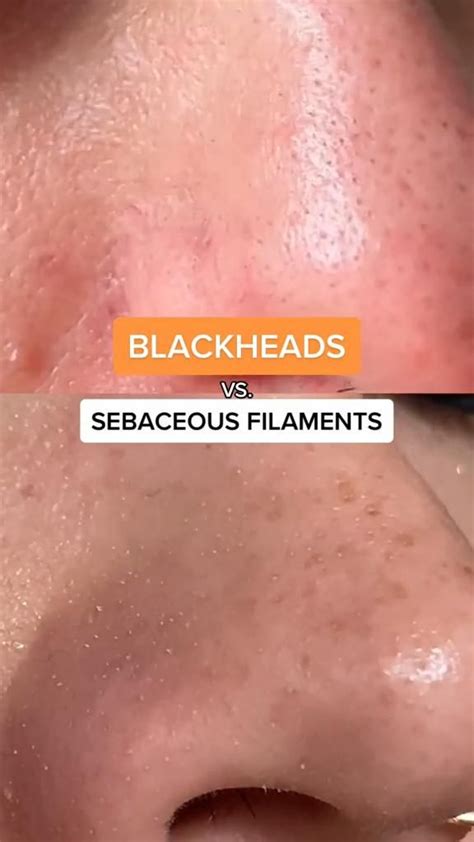 Blackheads Vs Sebaceous Filaments Dermatological Skin Care Healthy