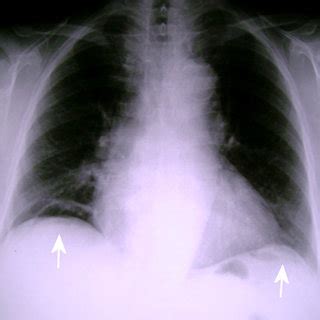 Upright Posteroanterior Chest Radiograph After Insufflating Air Into