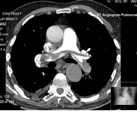 Saddle Pulmonary Embolism CTA Chest RadRounds Radiology Network