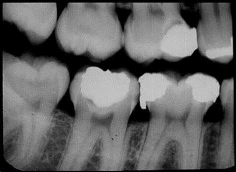 Rad Interpretation Of Dental Caries Ch33 Flashcards Quizlet