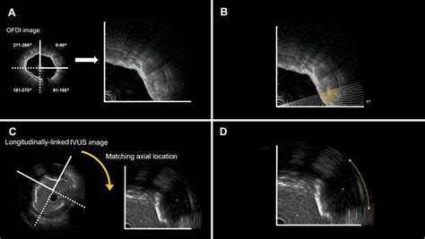 Evaluation Methods Of Coronary Calcium And Comparison Of Coronary