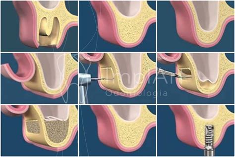 Enxerto ósseo levantamento do seio maxilar sinus lift ImplArt