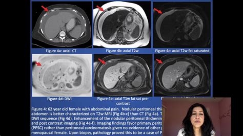 Role Of Mri In Primary Peritoneal Serous Carcinoma Youtube