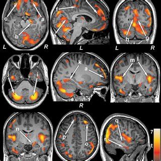 Brain Regions With Reduced Gray Matter Volume In T2DM Patients Over