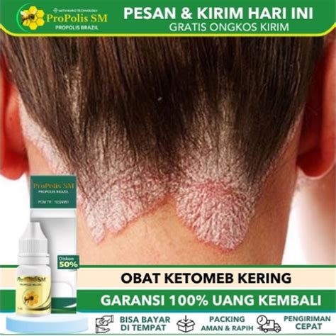 Jual Obat Ketombe Kering Ketombe Berkerak Ketombe Akut Ketombe