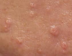 Dermatology Sebaceous Hyperplasia Kembara Xtra