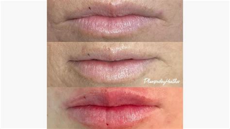 Hyaluronic Acid Lip Injections At Home At Mollysbradley Blog