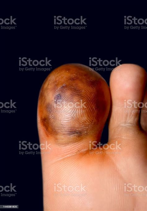 Abscess And Cellulitis Or Staphylococcal Streptococcal Skin Infection At The Big Toe Of Asian