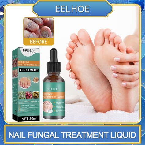 Eelhoe Herbaceous Nails Repairing Serum Onychomycosis Paronychia Anti