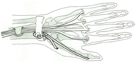 Tenodesis Of A Long Thumb Extensor Epl And Common Fingers Extensors