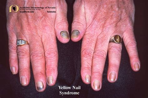 Yellow Nail Syndrome Yellow Nails Lymphedema Bronchiectasis Pleural