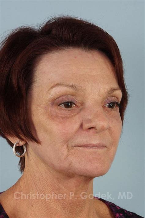 Before And After Laser Resurfacing In New Jersey The Godek Center