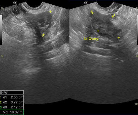 Ovarian Torsion Radiology Case Radiopaedia Org