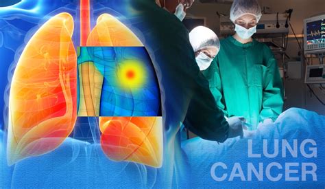 For Some Lung Cancer Patients Surgery May Yield Better Long Term Results