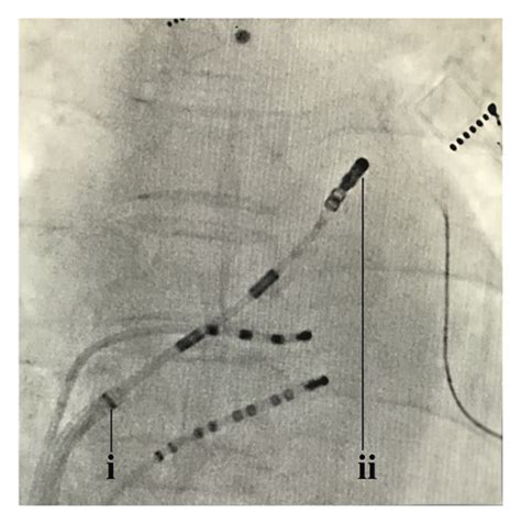 Fluoroscopic Views In Anteroposterior Projection Showing The Special