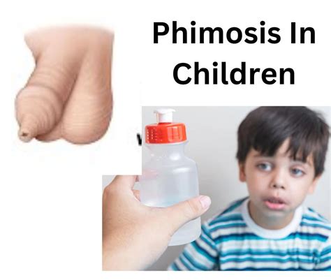 Phimosis Surgery Doctor In Pune Pediatric Surgeon Dr Geeta