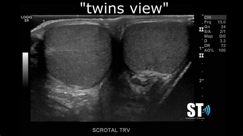 Testicular Scrotal Doppler Protocol Sonographic Tendencies