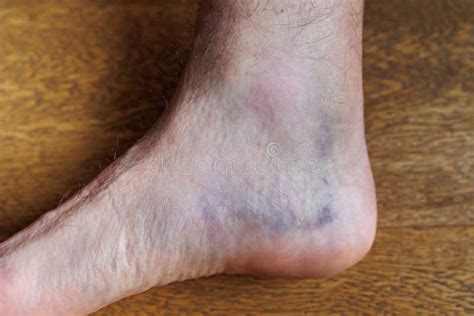 Large Bruise In The Heel Of The Foot After A Stretching Injury Stock